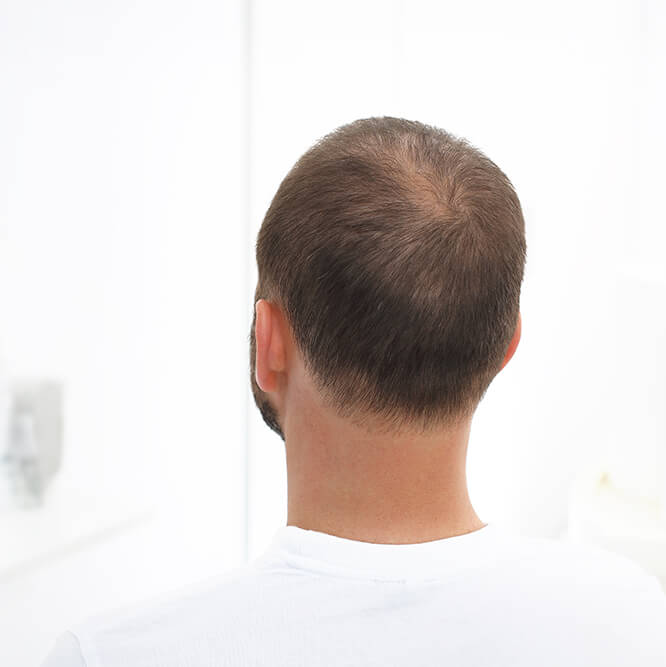 Hair Restoration Dallas | Hair Loss Treatment