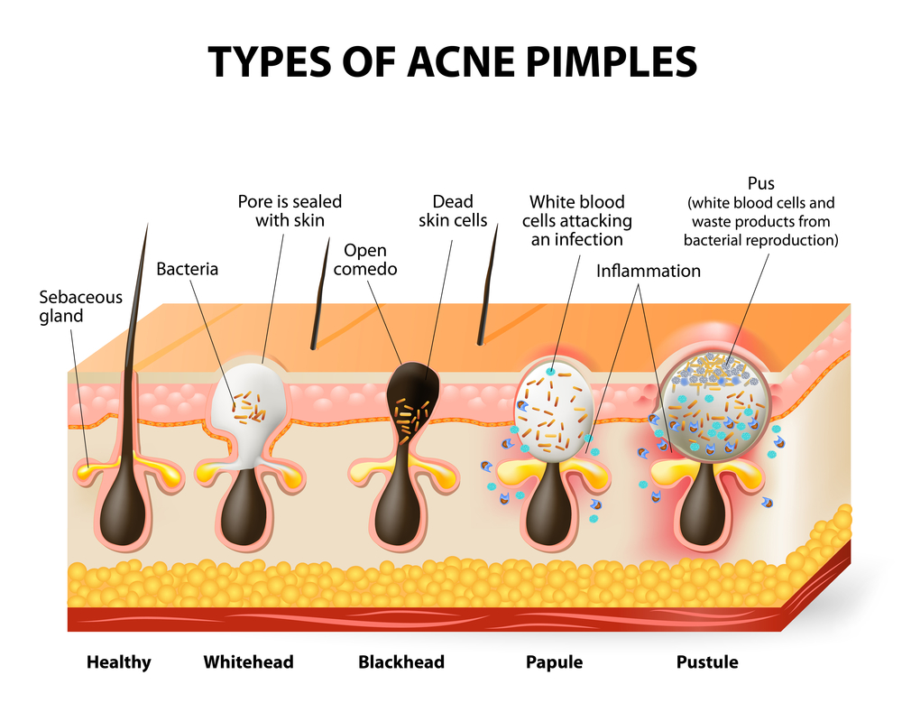 different types of acne