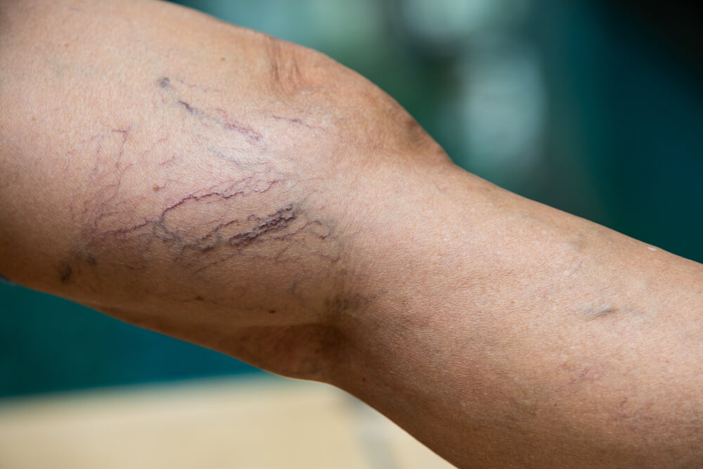 spider veins patient