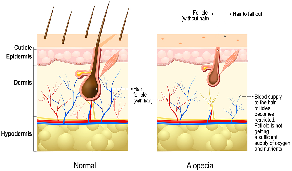 female hair loss