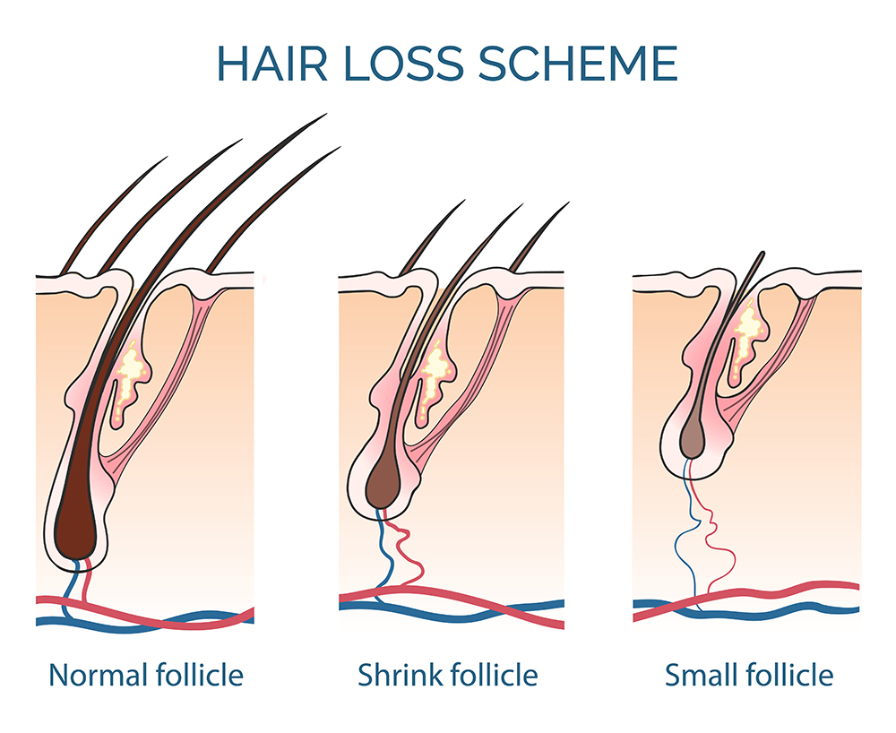 pattern of hair loss
