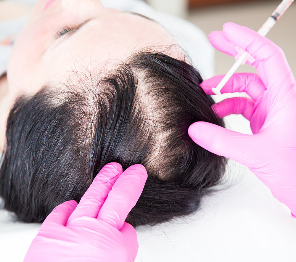 PRP Therapy Hair Restoration Dallas | Platelet Rich Plasma
