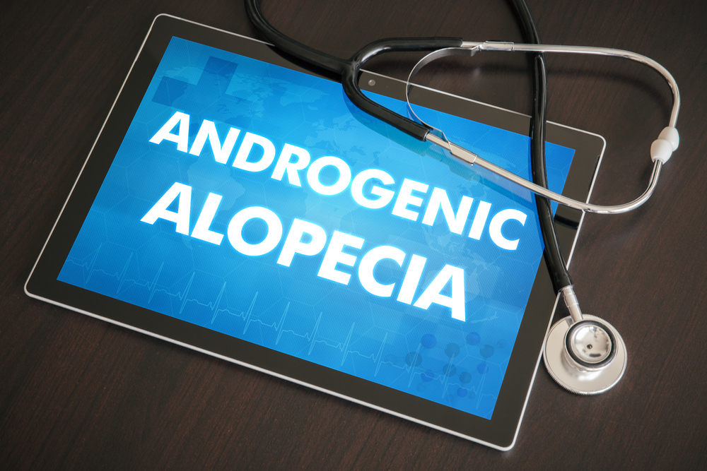 Androgenic Alopecia